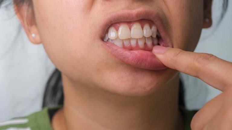 Beyazlatma işleminde yanlış uygulama diş kaybına neden olabilir