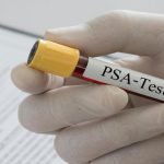 PSA Testi Nedir, Ne İşe Yarar? Yüksekliği ve Düşüklüğü Ne Anlama Gelir?
