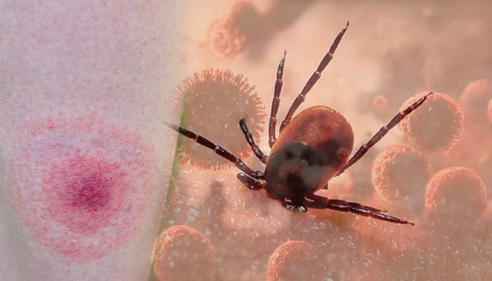 Kenelerden gelen tehlike: Lyme hastalığına yol açıyor: Bu belirtilere dikkat! Uzmanlar uyarıyor: “Lyme hastalığı ölümcül seyredebilir”