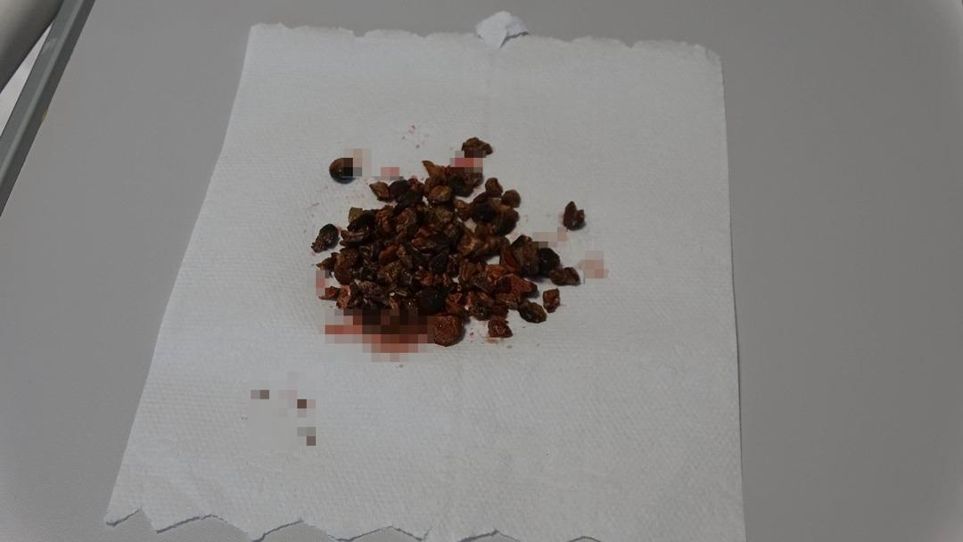 Doktorları şaşırtan durum: adamın böbreğinden neredeyse 100 taş: