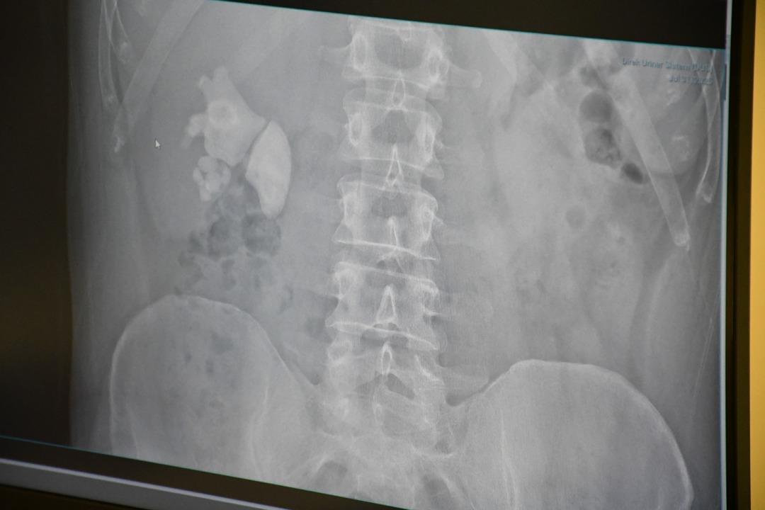 Doktorları şaşırtan durum: adamın böbreğinden neredeyse 100 taş: