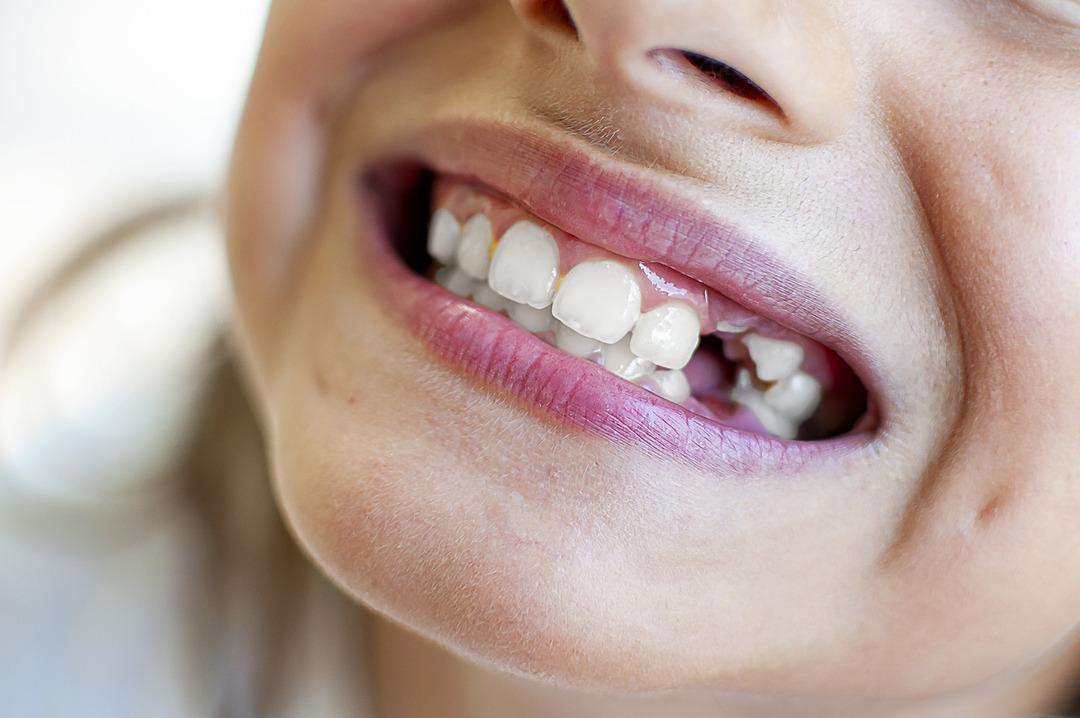 Uzmanların adından eleştirel bildirim: Tırnaklarda başlayan tehlike! Diş füzyon kökleri fark etmeden 2