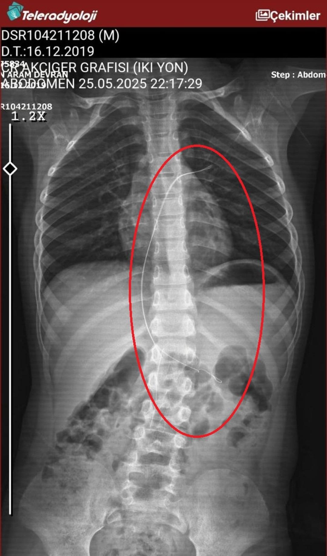 3 yıl sonra ortaya çıktı: 18 santimetre Catharers unuttu! Salatalık yutulduğunda ortaya çıktı 2