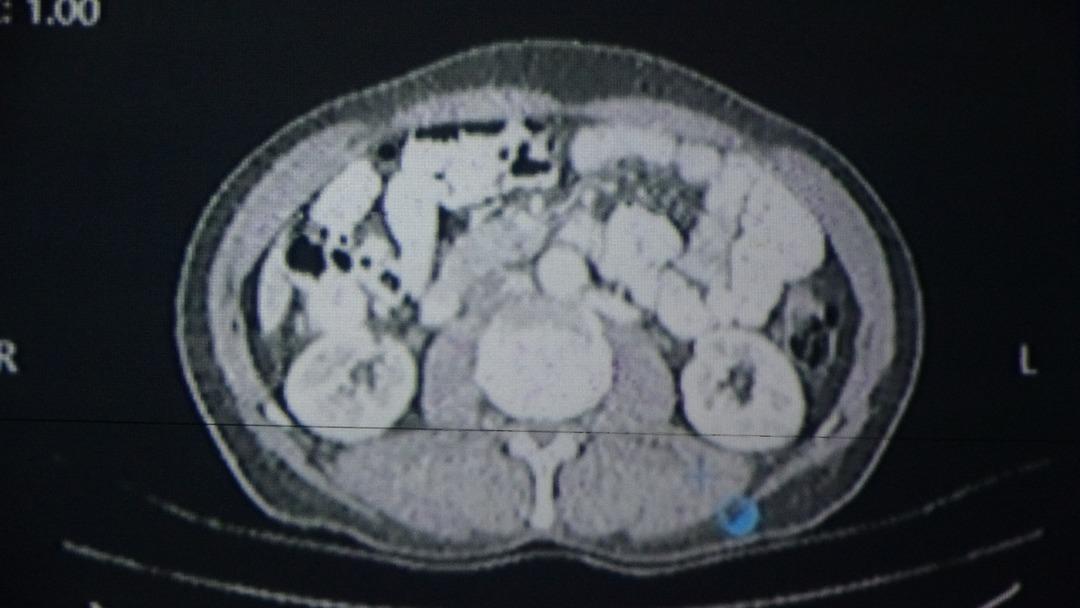 Dünya için bir örnekti! Türkiye'de bir ilk: Kanser tedavisinde yapay zeka kullanıldı 2