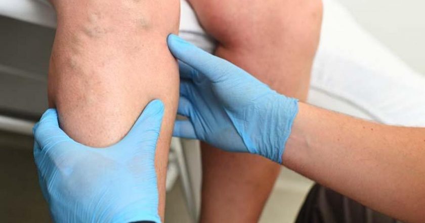 Gebelikte sol tarafa yatmak varis riskini azaltıyor