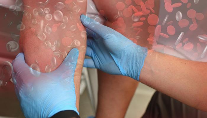 Modern çağın en sinsi ve ölümcül hastalığı: Türkiye’de her yıl 30 bin kişi tromboz nedeniyle hayatını kaybediyor!