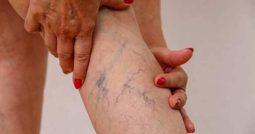 Varikosel Nedir, Beliritleri Nelerdir? Varikosel Tedavisi Nasıl Yapılır?