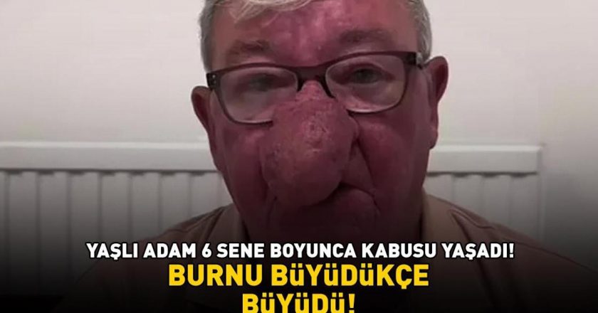 Burnu büyüdükçe büyüdü! 68 yaşındaki adam kabusu yaşadı! 4 saatlik operasyonla adeta yeniden doğdu