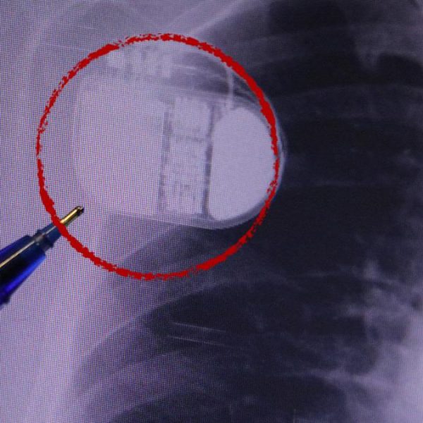 Kalp pili taşıyanlar dikkat! Soğuk hava uyarısı: “Titreme cihazı yanıltabilir”Sağlık Haberleri