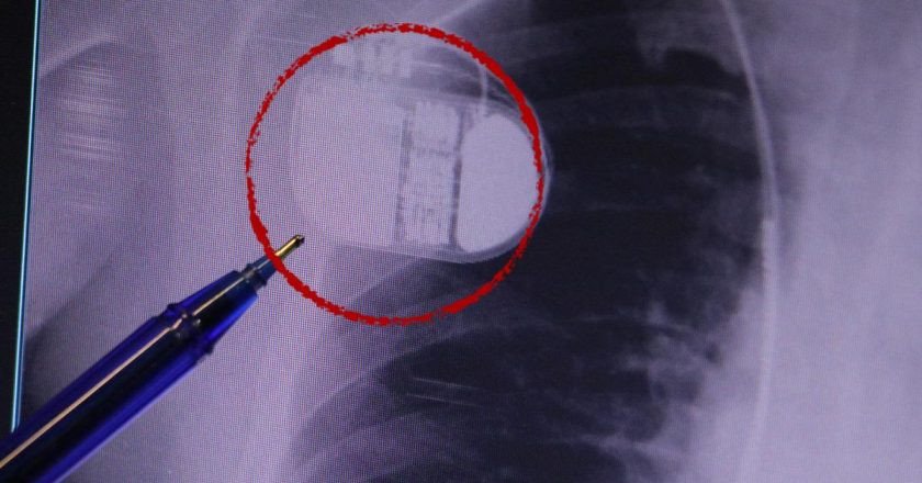 Kalp pili taşıyanlar dikkat! Soğuk hava uyarısı: “Titreme cihazı yanıltabilir”Sağlık Haberleri