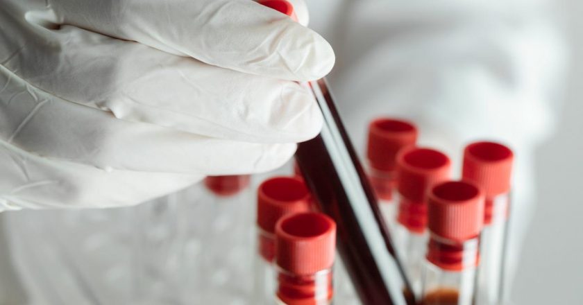 Dünyada sadece 50 kişide var! ‘Altın kan’ın sırrı çözülüyor: Bir damlası bile servet değerinde!