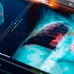 Türkiye’de her yıl 45 bin yeni vaka! Bu illere dikkat: Risk daha fazla!