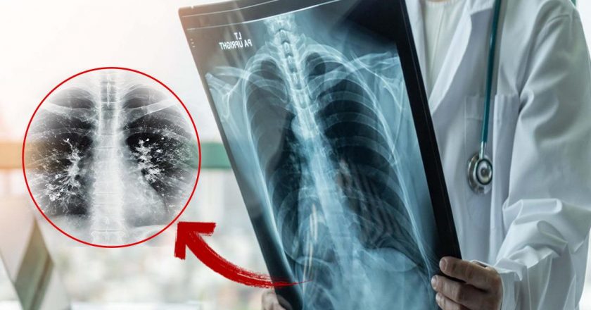 Gribi atlattınız mı? Asıl tehlike şimdi başlıyor: ‘süperenfeksiyon’ uyarısı